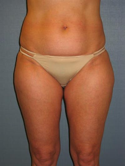 Power Assisted Liposuction Before & After Gallery - Patient 1310933 - Image 2