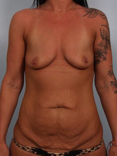 Breast Augmentation Before & After Gallery - Patient 1310937 - Image 1