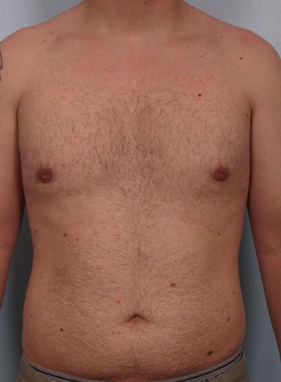 Male Breast/Areola Reduction Gallery - Patient 1310934 - Image 4
