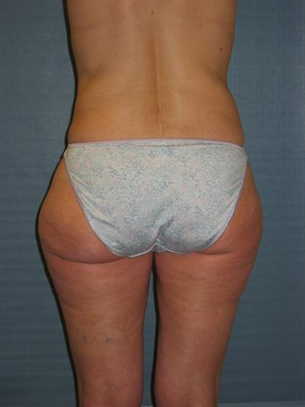 Power Assisted Liposuction Before & After Gallery - Patient 1310933 - Image 3