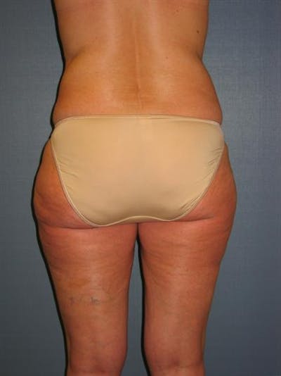 Power Assisted Liposuction Before & After Gallery - Patient 1310933 - Image 4