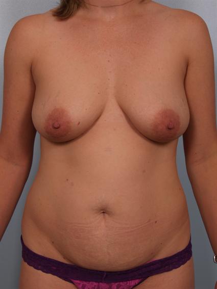 Image4 - Before image of Tummy Tuck in Beverly Hills by Dr. Cohen.