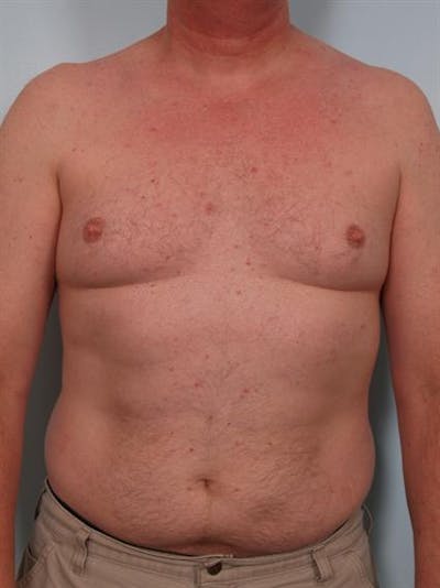 Male Breast/Areola Reduction Gallery - Patient 1310942 - Image 1