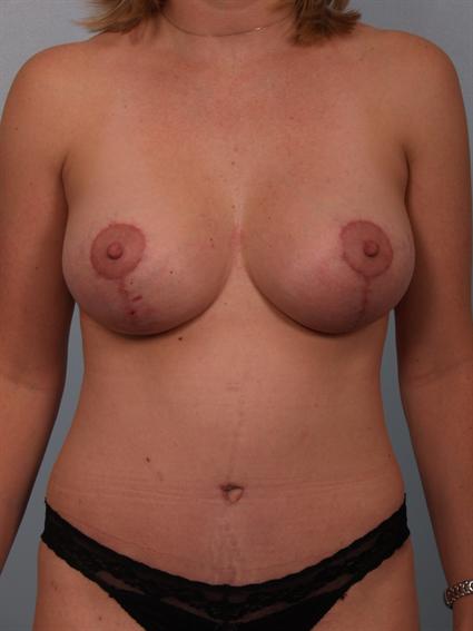 Image4 - After image of Tummy Tuck in Beverly Hills by Dr. Cohen.