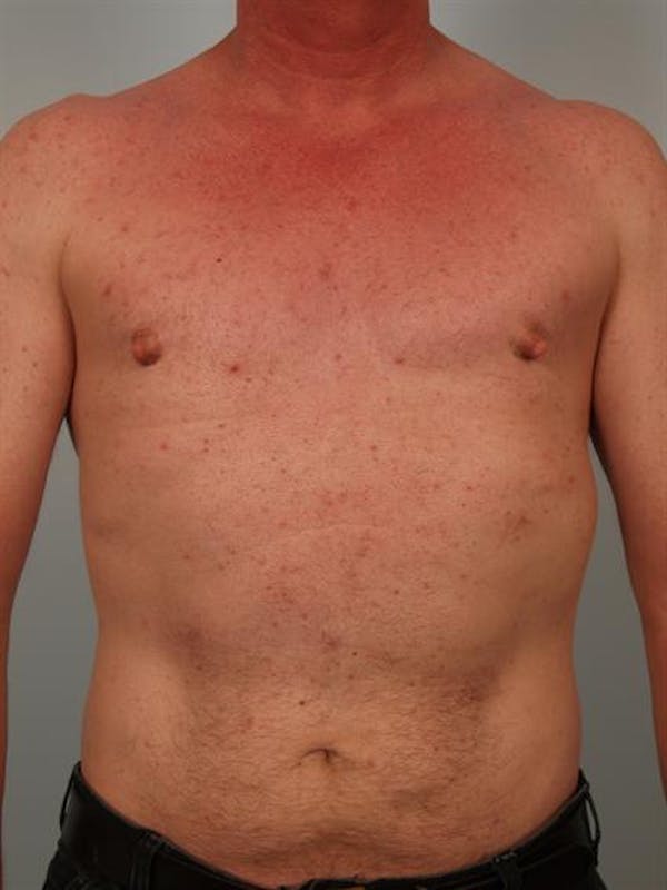 Male Breast/Areola Reduction Before & After Gallery - Patient 1310942 - Image 2