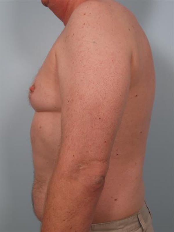 Male Breast/Areola Reduction Before & After Gallery - Patient 1310942 - Image 3
