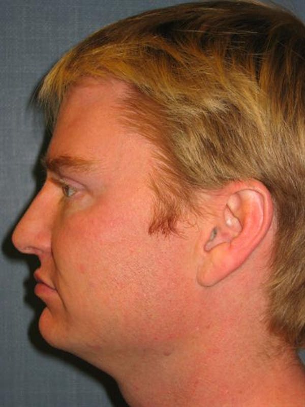 Botox Before & After Gallery - Patient 1310939 - Image 6