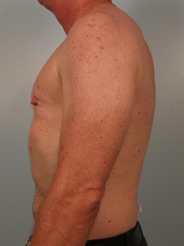 Male Breast/Areola Reduction Before & After Gallery - Patient 1310942 - Image 4