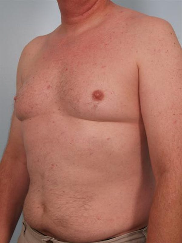 Male Breast/Areola Reduction Before & After Gallery - Patient 1310942 - Image 5