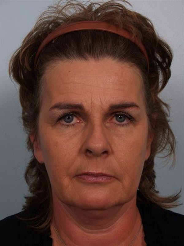 Botox Before & After Gallery - Patient 1310945 - Image 1