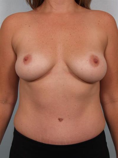 Tummy Tuck Before & After Gallery - Patient 1310948 - Image 2