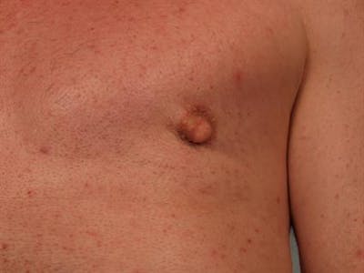 Male Breast/Areola Reduction Before & After Gallery - Patient 1310942 - Image 6