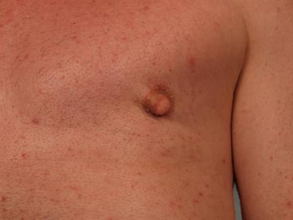 Male Breast/Areola Reduction Before & After Gallery - Patient 1310942 - Image 6