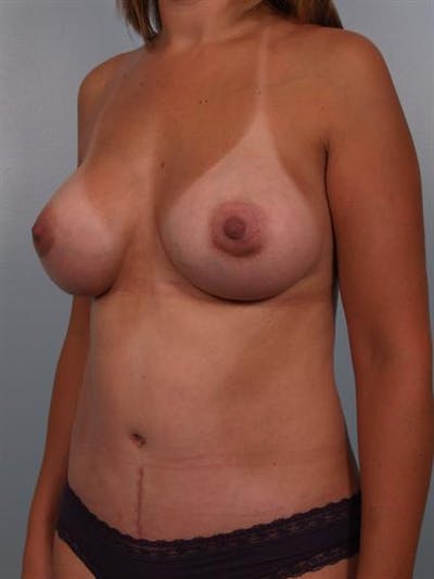 Mommy Makeover Before & After Gallery - Patient 1310943 - Image 6