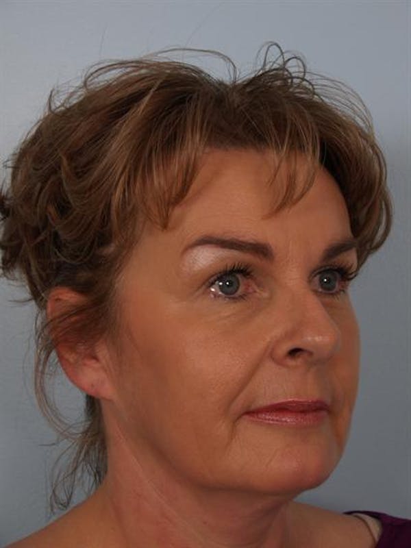 Botox Before & After Gallery - Patient 1310945 - Image 4
