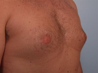 Male Breast/Areola Reduction Before & After Gallery - Patient 1310951 - Image 1