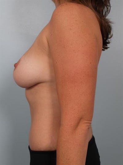 Tummy Tuck Before & After Gallery - Patient 1310948 - Image 4