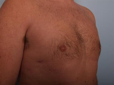 Male Breast/Areola Reduction Before & After Gallery - Patient 1310951 - Image 2