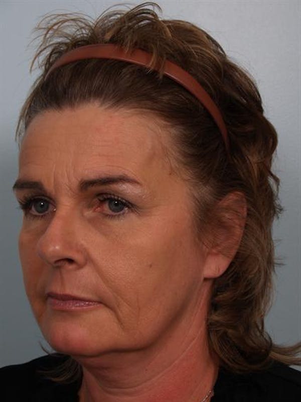 Botox Before & After Gallery - Patient 1310945 - Image 5