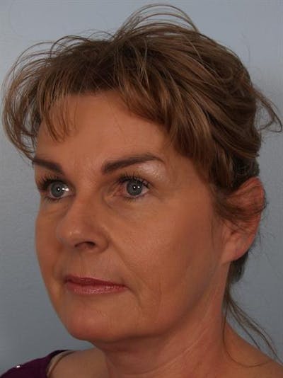 Botox Before & After Gallery - Patient 1310945 - Image 6