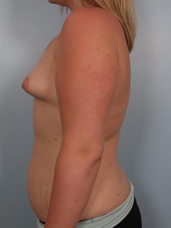 Breast Lift Before & After Gallery - Patient 1310950 - Image 3