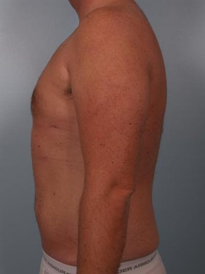 Male Breast/Areola Reduction Gallery - Patient 1310951 - Image 4