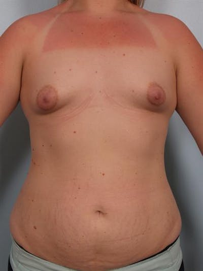 Breast Lift Before & After Gallery - Patient 1310950 - Image 1