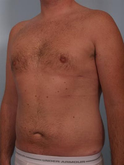 Male Breast/Areola Reduction Before & After Gallery - Patient 1310951 - Image 6