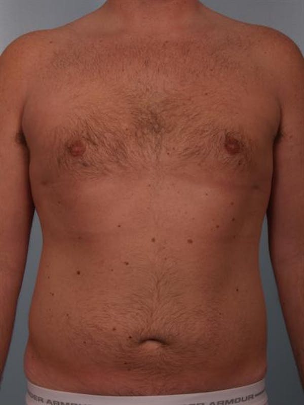 Male Breast/Areola Reduction Before & After Gallery - Patient 1310951 - Image 10