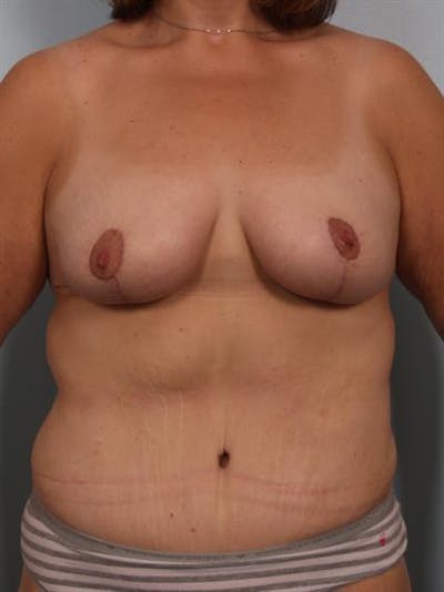 Tummy Tuck Before & After Gallery - Patient 1310954 - Image 6