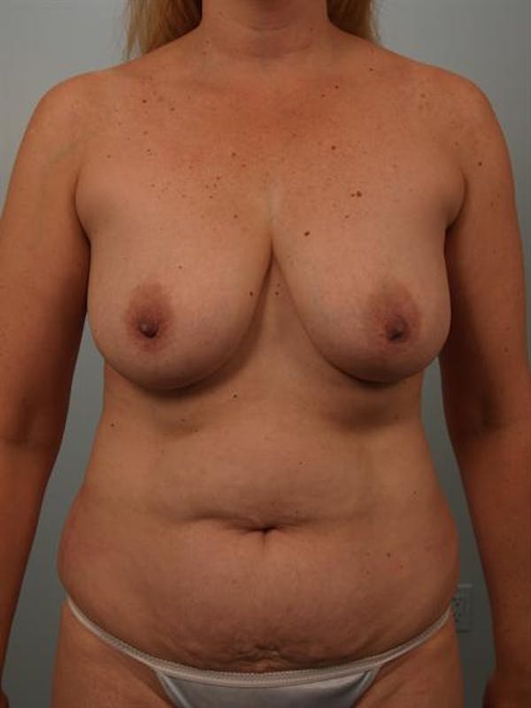 Breast Lift Gallery - Patient 1310962 - Image 1