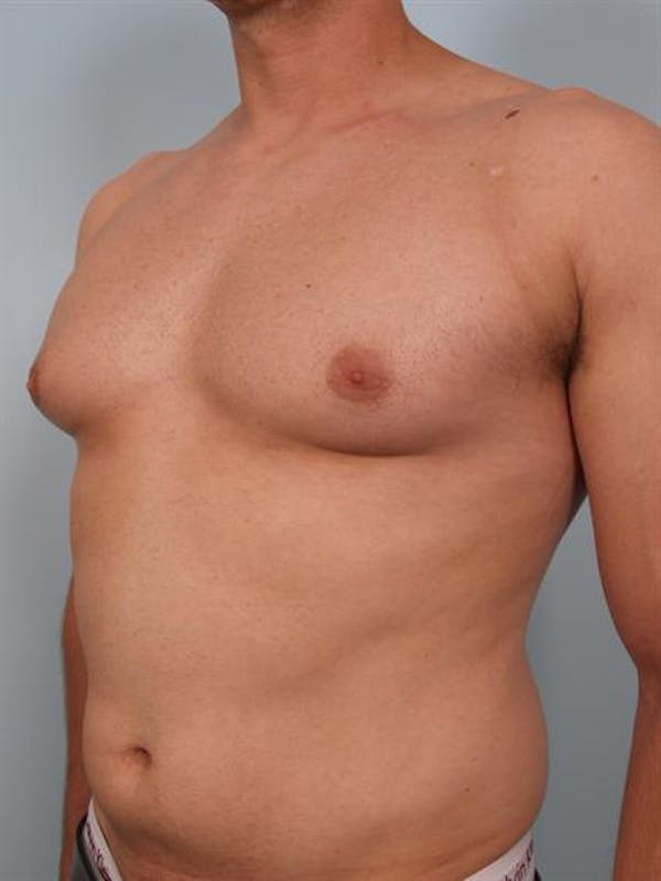 Male Breast/Areola Reduction Before & After Gallery - Patient 1310958 - Image 1