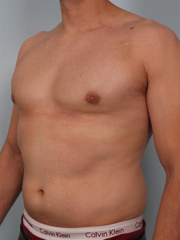 Male Breast/Areola Reduction Gallery - Patient 1310958 - Image 2
