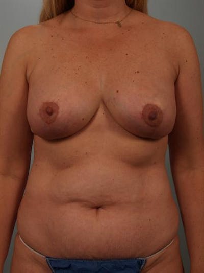 Breast Lift Before & After Gallery - Patient 1310962 - Image 2