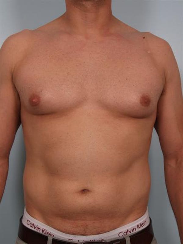 Male Breast/Areola Reduction Before & After Gallery - Patient 1310958 - Image 3