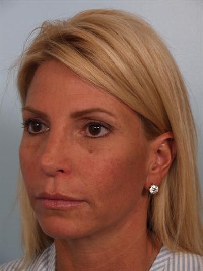 Restylane Before & After Gallery - Patient 1310963 - Image 2