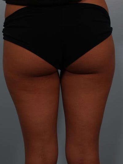 Power Assisted Liposuction Before & After Gallery - Patient 1310961 - Image 1
