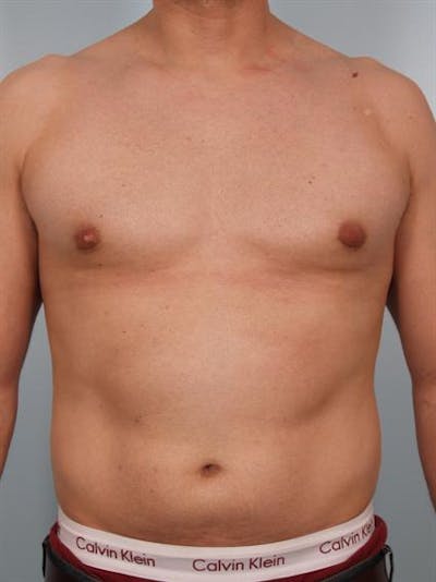 Male Breast/Areola Reduction Before & After Gallery - Patient 1310958 - Image 4
