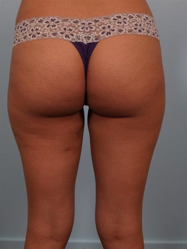 Power Assisted Liposuction Before & After Gallery - Patient 1310961 - Image 2