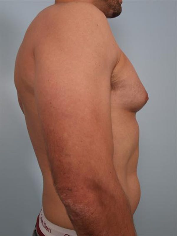 Male Breast/Areola Reduction Before & After Gallery - Patient 1310958 - Image 5