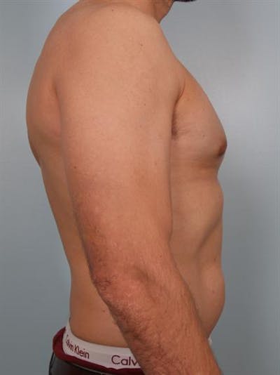 Male Breast/Areola Reduction Before & After Gallery - Patient 1310958 - Image 6