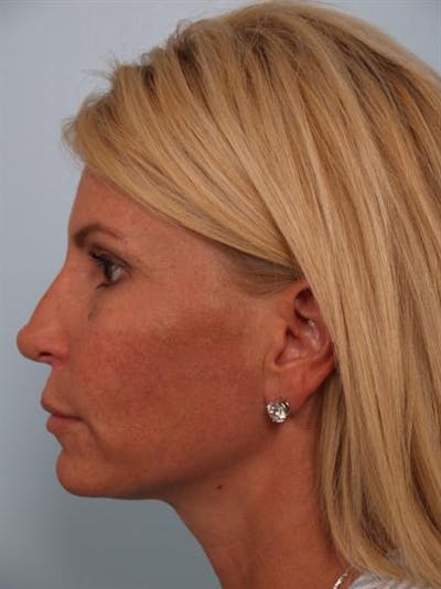 Restylane Before & After Gallery - Patient 1310963 - Image 6