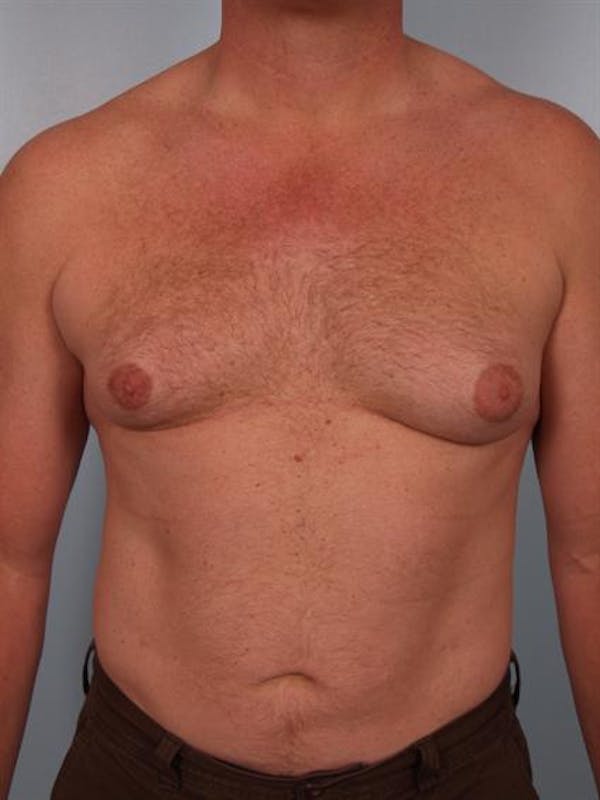 Male Breast/Areola Reduction Gallery - Patient 1310967 - Image 1