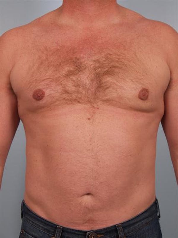 Male Breast/Areola Reduction Before & After Gallery - Patient 1310967 - Image 2