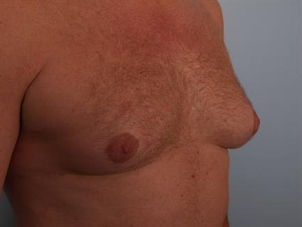 Male Breast/Areola Reduction Before & After Gallery - Patient 1310967 - Image 3
