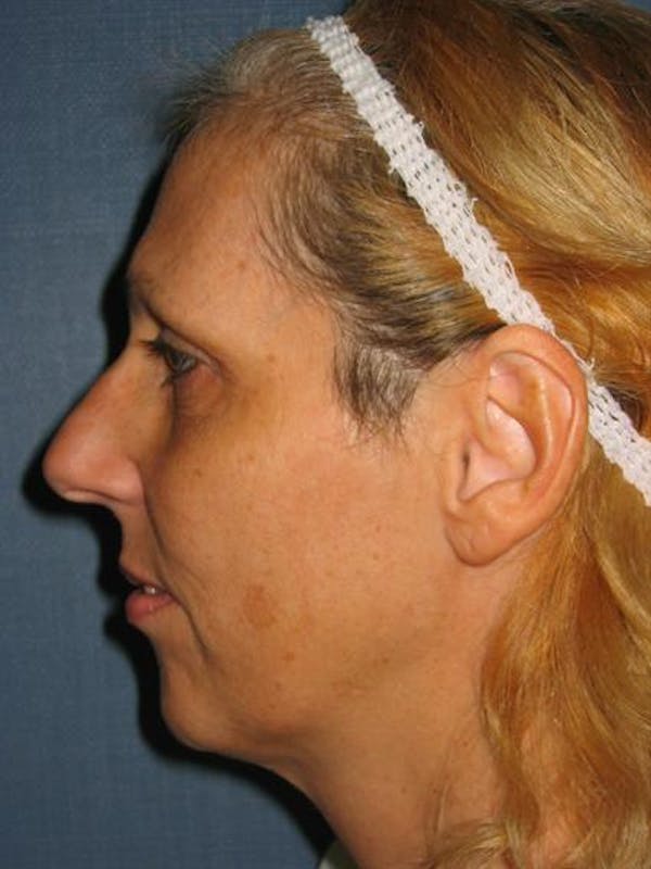 Restylane Before & After Gallery - Patient 1310964 - Image 1