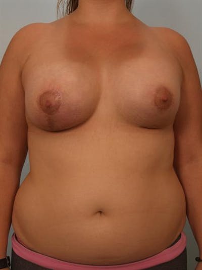 Breast Lift Before & After Gallery - Patient 1310970 - Image 2