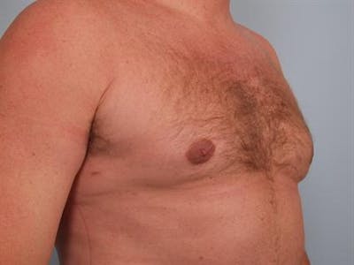 Male Breast/Areola Reduction Before & After Gallery - Patient 1310967 - Image 4
