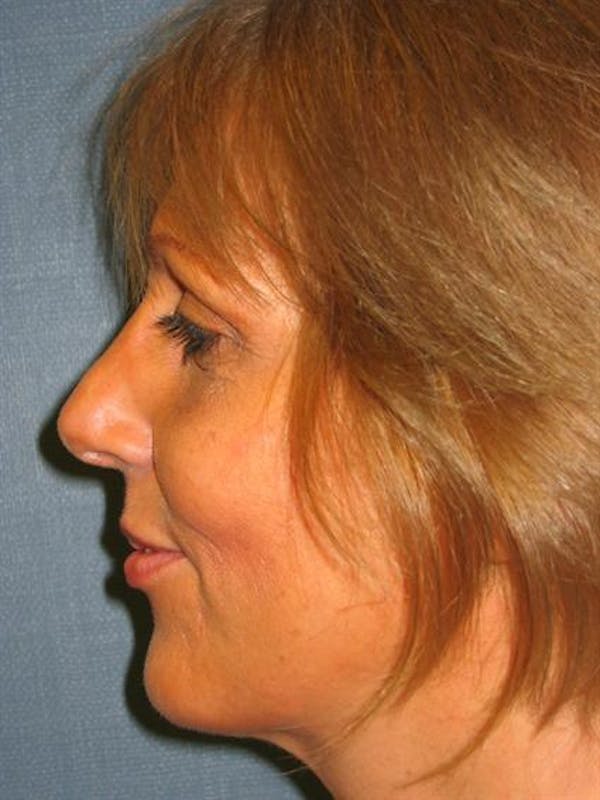 Restylane Before & After Gallery - Patient 1310964 - Image 2