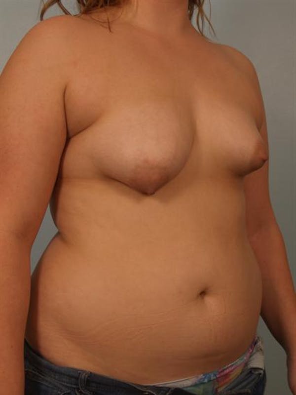 Breast Lift Before & After Gallery - Patient 1310970 - Image 3